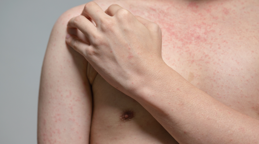 Giderek artan kızamık vakaları endişe yarattı! Ölümcül salgın yeniden başlayabilir