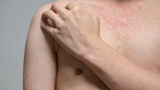 Giderek artan kızamık vakaları endişe yarattı! Ölümcül salgın yeniden başlayabilir