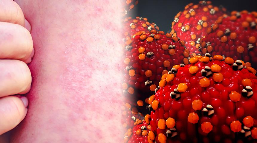 Kızamık yeniden hortladı, Sağlık Bakanlığı harekete geçti! Anne ve babalar dikkat: 'Anahtar deliğinden bile bulaşır'