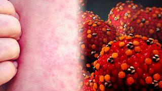 Kızamık yeniden hortladı, Sağlık Bakanlığı harekete geçti! Anne ve babalar dikkat: 'Anahtar deliğinden bile bulaşır'