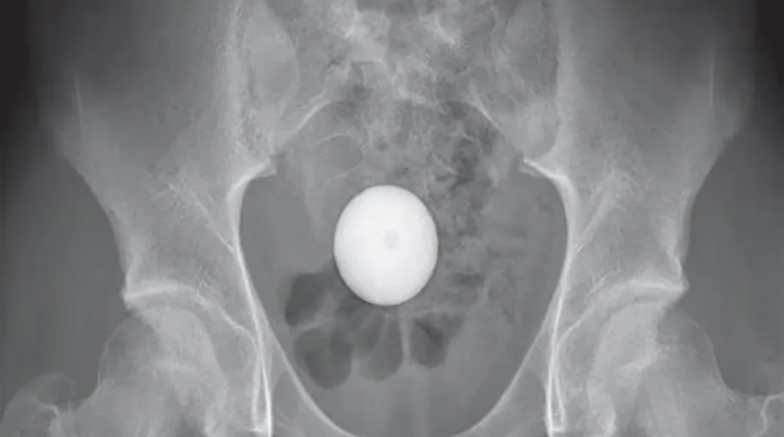 Doktorlar şaştı kaldı! Golf topunu çıkartamayınca soluğu hastanede aldı