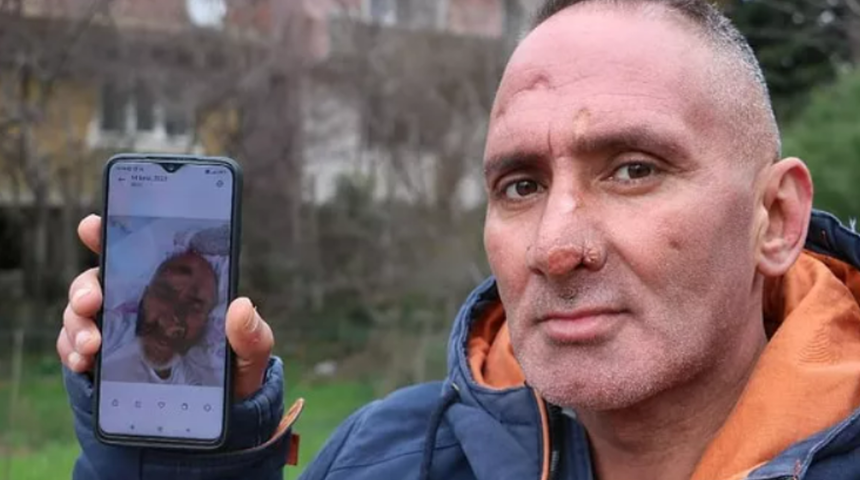 Sinek ısırığıyla hayatının kabusunu yaşadı! Yüzü tanınamayacak hale geldi