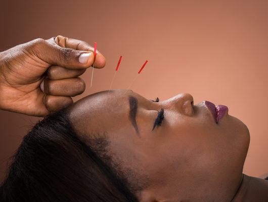Akupunktur ile migren tedavisi nasıl yapılır? 