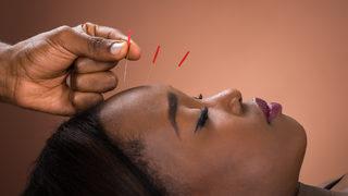 Akupunktur ile migren tedavisi nasıl yapılır? Akupunktur migren ağrısına iyi gelir mi, nasıl tedavi edilir?