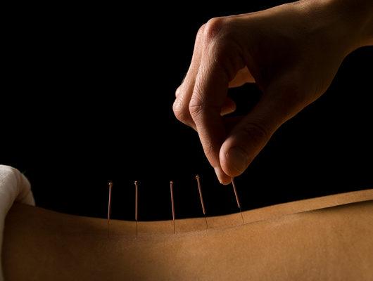 Cinsel sağlık için akupunktur nasıl kullanılır? 