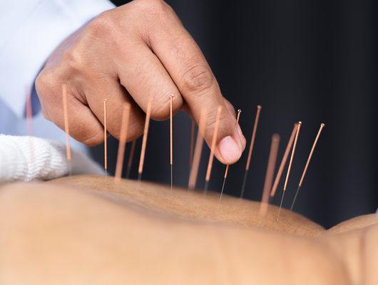 Akupunkturun zararı var mı?