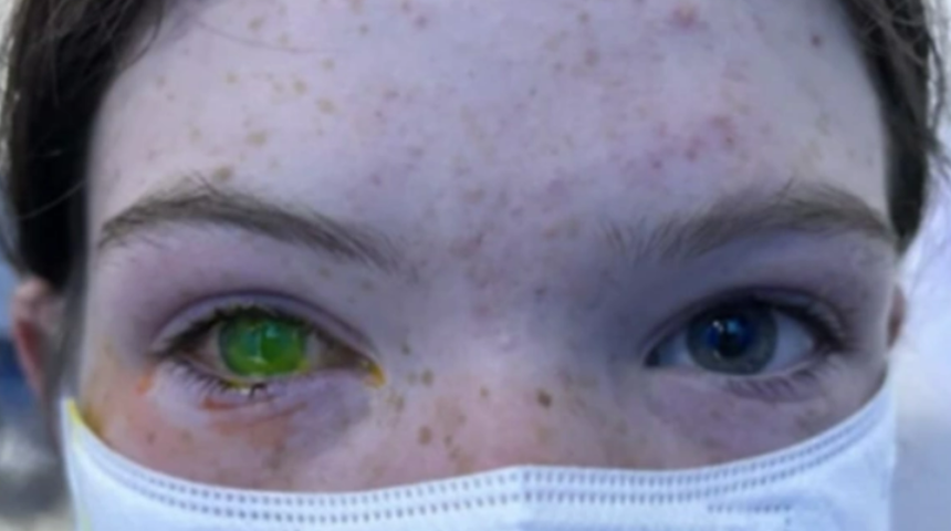 Zararsız diyerek geçmeyin! Bu böcek göz renginin değişmesine neden oluyor