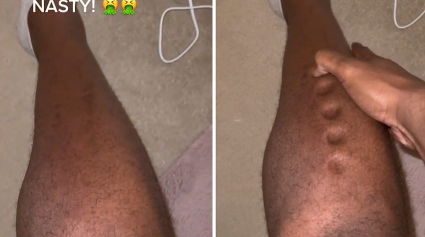 Sessiz katil'in önemli belirtisi! Vücudu oyun hamuruna dönen adam yaşadıklarını paylaştı