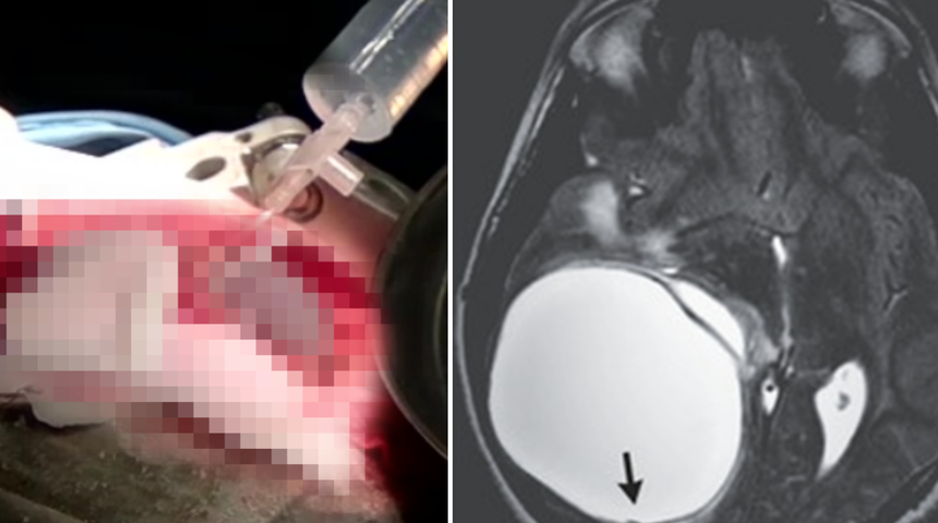 Her şey baş ağrısıyla başladı! Beyninden yumruk büyüklüğünde tümör çıkartıldı