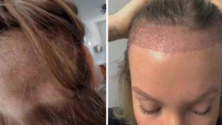 Geniş alnını gizlemek için saç ektirdi! Saç ekimi aşamalarını TikTok hesabında paylaştı