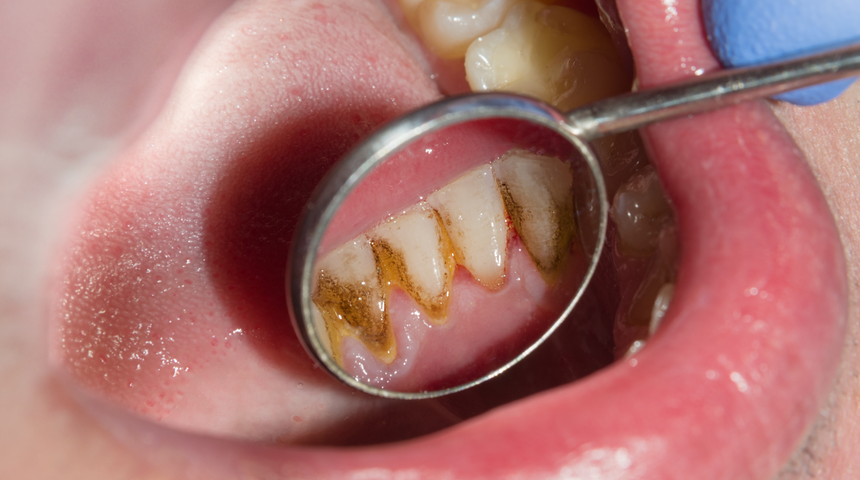 Bu hatadan kaçının! Diş tartarlarının oluşmasına neden oluyor