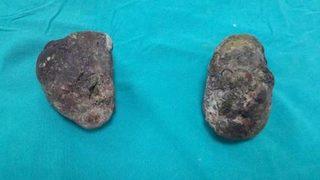 1,5 kilo Trabzon hurması yedi! Midesinden iki taş çıkarıldı