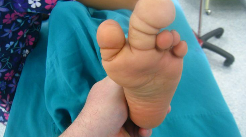 Makrodaktili hastalığı nedir? El ve ayakta görülen bu belirtilerle başlıyor