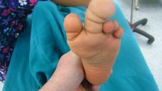 Makrodaktili hastalığı nedir? El ve ayakta görülen bu belirtilerle başlıyor