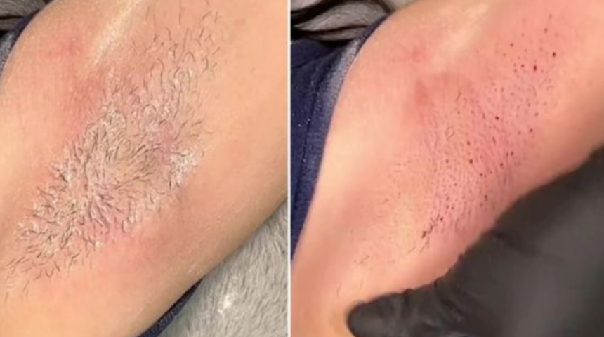 Profesyonel ağdacı ağda sırasında yaşanan kanamaların nedenini a&ccedil;ıkladı