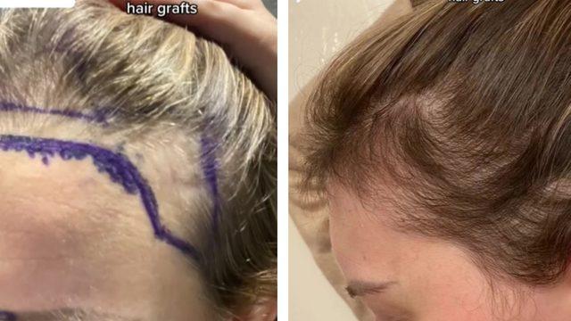 Geniş alnından kurtulmak için saç ektirdi! Saç ekim sürecinin her detayını paylaştı
