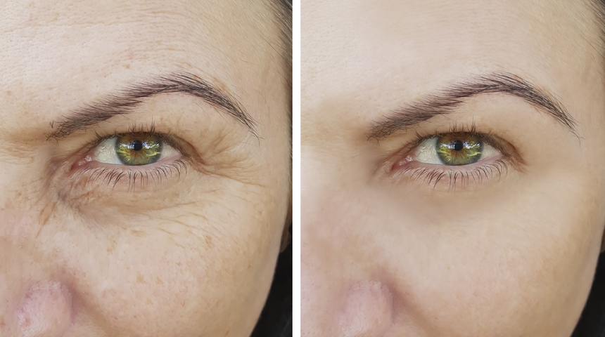 Kırışık karşıtı kremlere para vermeye son! Bu baharat botoks etkisi yaratıyor