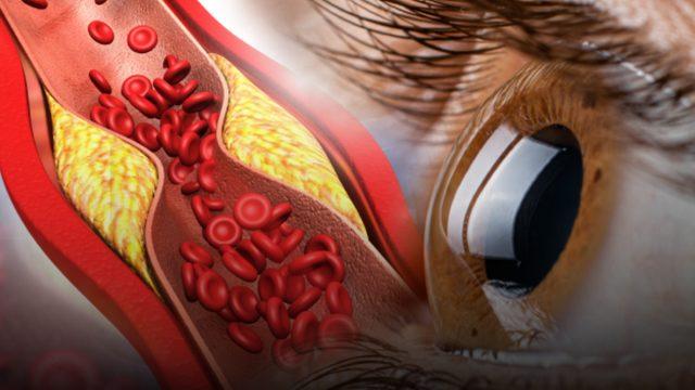 Gözlerde ortaya çıkan bu duruma dikkat! Yüksek kolesterolün bilinmeyen işareti