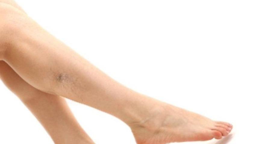 Varis tedavisinde alışılmadık bir y&ouml;ntem : Yapıştırıcı (Zamk)