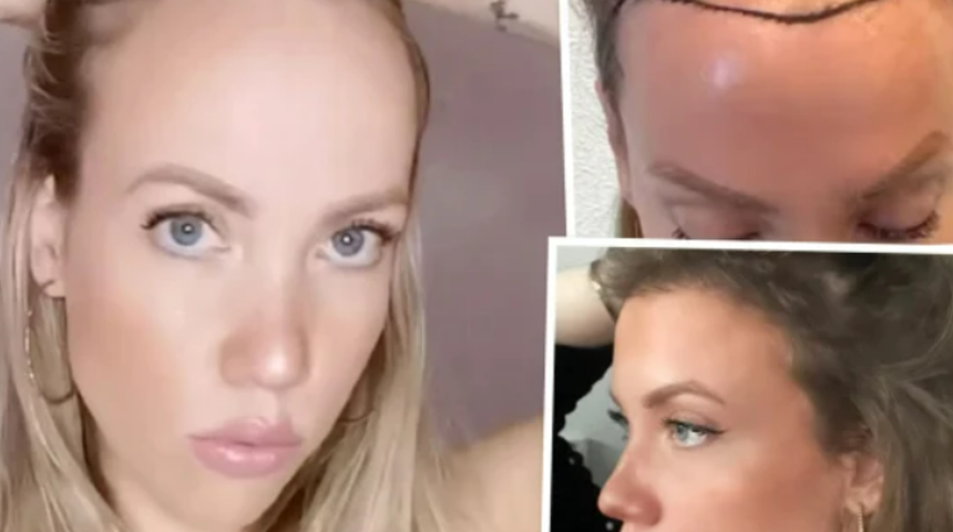 Geniş alnını kapattırmak için kakül kestirmek yerine saç ekimini tercih etti! Türkiye'de yaptırdığı saç ekiminin detaylarını paylaştı