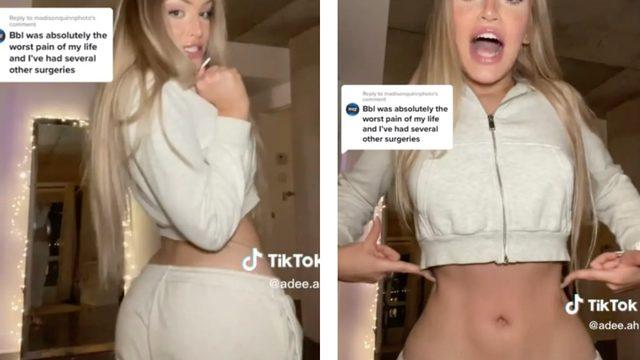 Yaptırdığı kalça estetiği yüzünden hayatı karardı! Vücudumun her yeri yanmış gibi