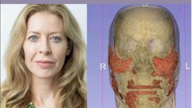 Botoksun verdiği hasar ortaya çıktı! 20 yıllık kimyasal...