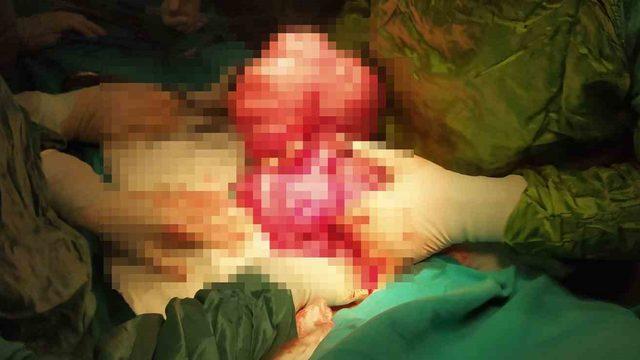 Kilo aldığını sanıyordu, karnından çıkanlar şaşkına çevirdi! 'İkiz bebek gibiymiş'