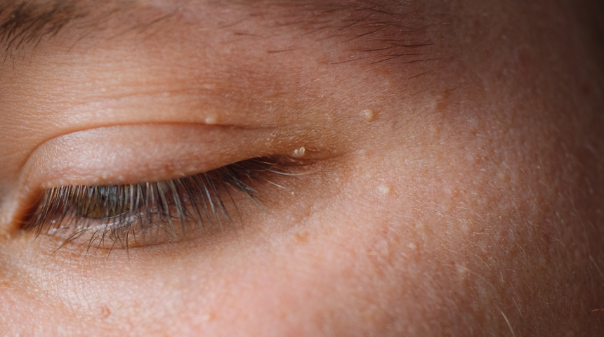 Türk araştırmacılar buldu! Diyabetin ciltteki bilinmeyen belirtisi... Hemen kontrol edin! 