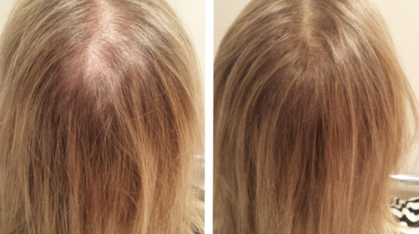 Saç dökülmesini anında durduruyor! Tüm dökülen saçlarınızı geri kazandıran maske tarifi