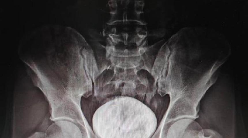 Röntgende tespit edildi! Makatından çıkanlar şaşkına çevirdi
