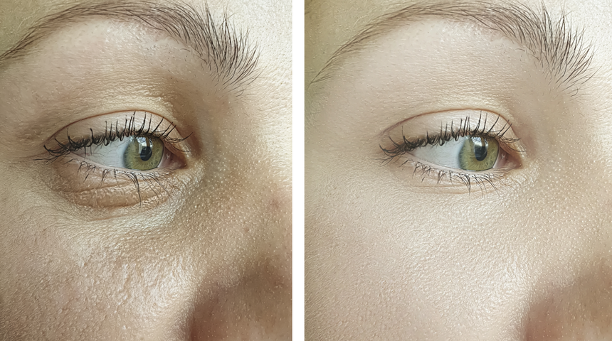 Yaşlılık belirtilerini anında geçiriyor! Botoks etkisi yaratan maske tarifi