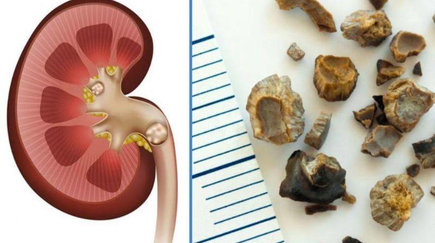 Oruçluyken böbrek taşı kırdırılır mı? Damardan alınan radyoaktif maddeler orucu bozar mı?