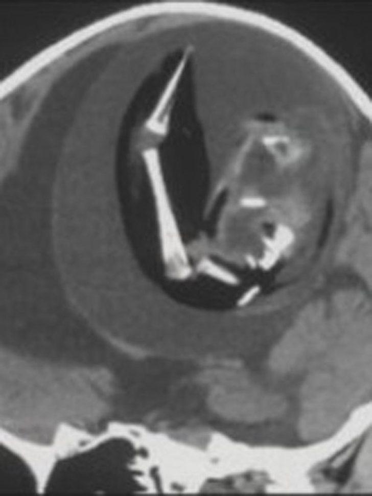 Doktorlar bile şaşkına döndü! Bir yaşındaki çocuğun kafasının içinden ikizinin fetüsü çıkartıldı G1