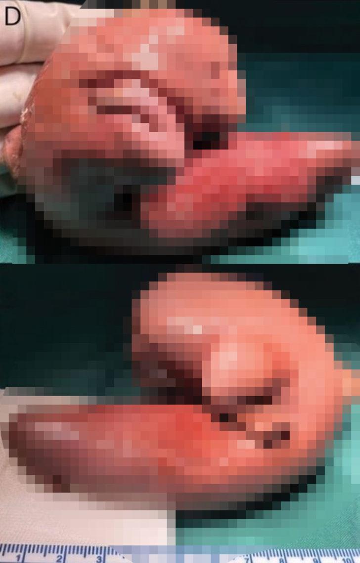 Doktorlar bile şaşkına döndü! Bir yaşındaki çocuğun kafasının içinden ikizinin fetüsü çıkartıldı G2