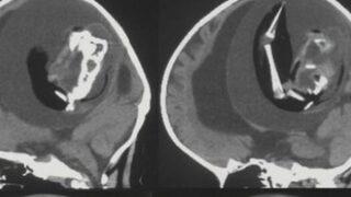 Doktorlar bile şaşkına döndü! Bir yaşındaki çocuğun kafasının içinden ikizinin fetüsü çıkartıldı