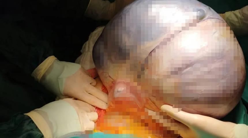 Karın ağrısı şikayetiyle hastaneye gitti, karnından çıkan kitle şaşkına çevirdi