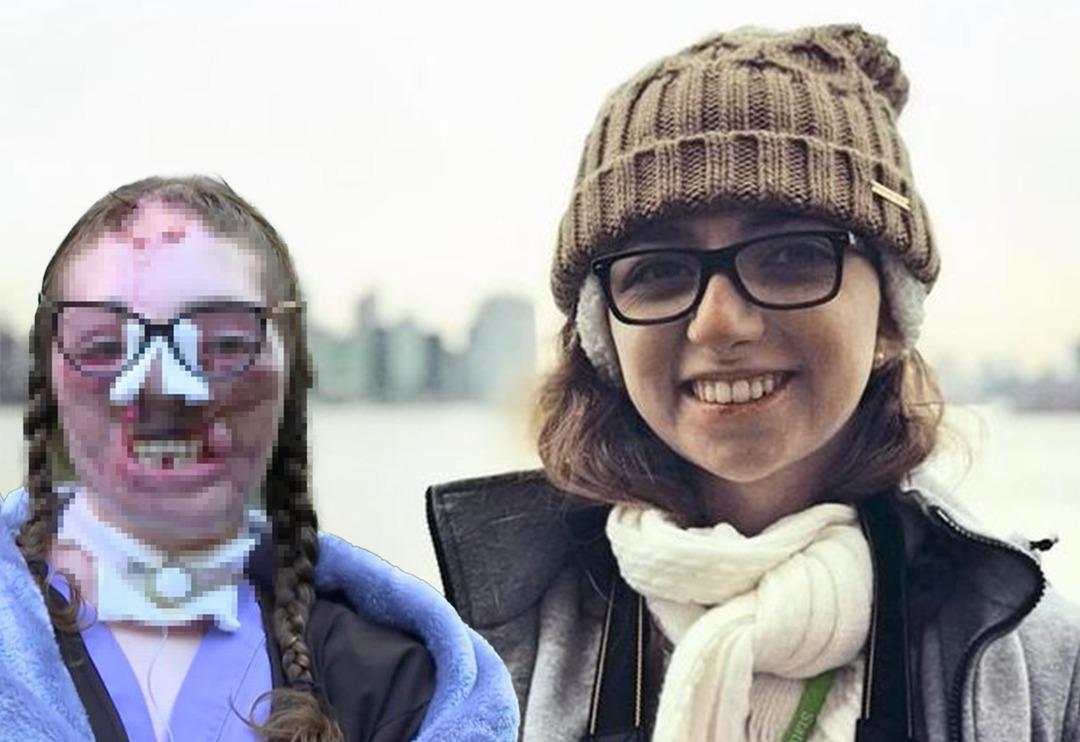 K&ouml;pekler tarafından 800 kez ısırılmıştı! 18 ameliyatın sonunda yeni halini paylaştı... Sosyal medyada g&uuml;ndem yarattı