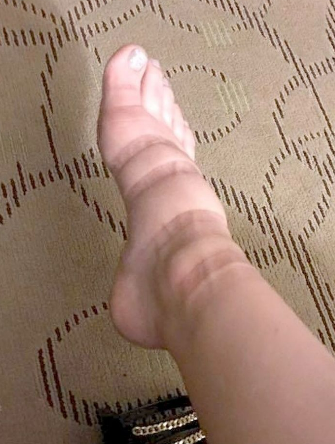 От носков остаются следы от резинок. Отпечаток на коже от резинки.