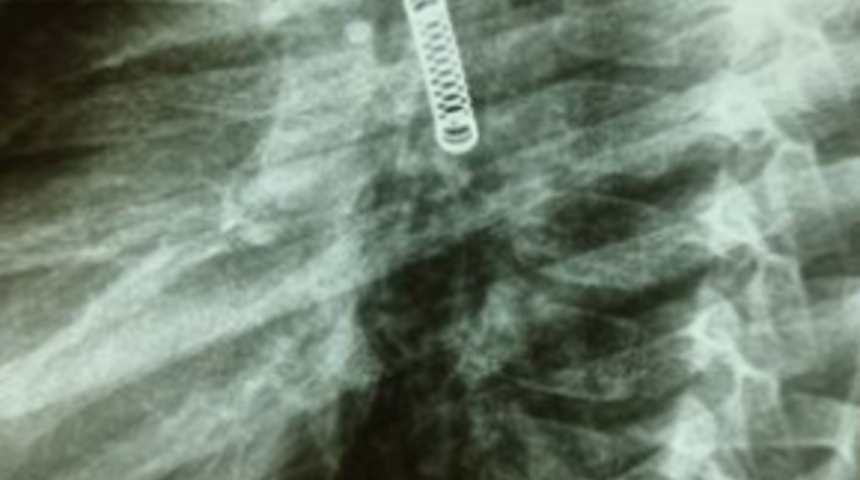 3 ay boyunca sürekli olarak öksürdü! 5 yaşındaki çocuğun akciğerinden çıkan şaşkına çevirdi