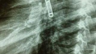 3 ay boyunca sürekli olarak öksürdü! 5 yaşındaki çocuğun akciğerinden çıkan şaşkına çevirdi