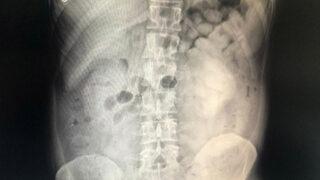 Diyarbakır'da şüpheli tavırları ele verdi! Hepsi midesinden çıktı, tam 800 adet