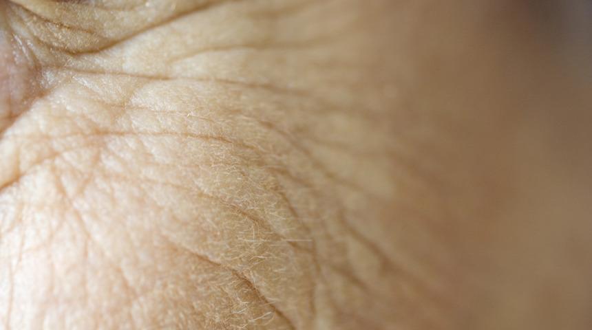 Kaz ayağı sorununa organik çözüm getiriyoruz