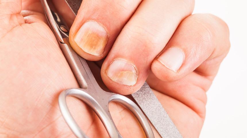 Tırnaktaki sararmanın geçmesi için neler yapılabilir?