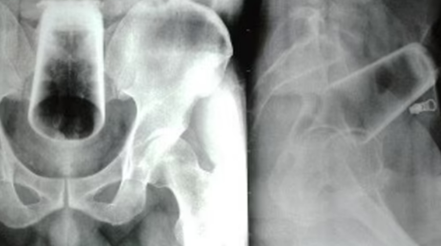 Sarhoşken içine soktuğu maddeyi gören doktorlar şok oldu! İtirafı olay yarattı