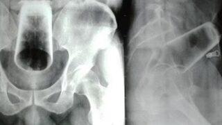 Sarhoşken içine soktuğu maddeyi gören doktorlar şok oldu! İtirafı olay yarattı