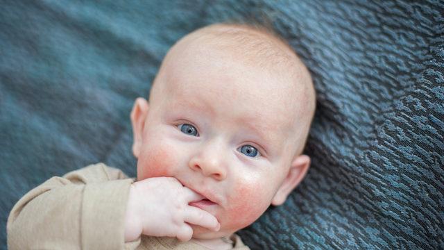 Bebeklerde alerji belirtileri ve tedavi yöntemleri nelerdir? Bebeklerde besin alerjisi nasıl anlaşılır?