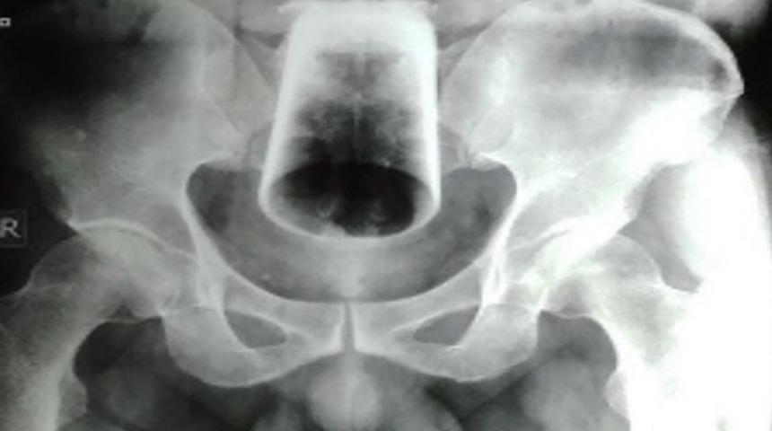 Sarhoşken yaptığını hatırlayamadı! Anüsünde cam bardak günlerce kaldı... Sonunda hastanelik oldu