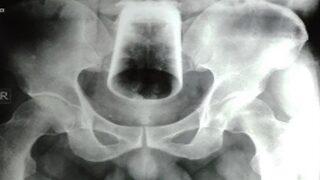 Sarhoşken yaptığını hatırlayamadı! Anüsünde cam bardak günlerce kaldı... Sonunda hastanelik oldu