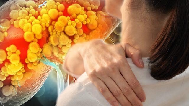 Karaciğerin bittiğini gösteren işarete dikkat! Hastaların yüzde 82'si aynı belirtiyi yaşıyor