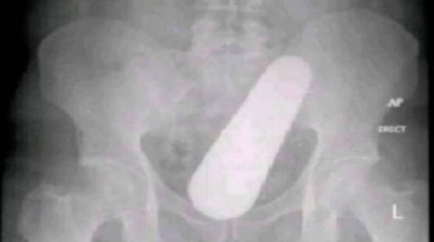 Cinsel organında salatalık sıkıştı! Bahanesi ‘pes’ dedirtti... “Çok fazla yediğim için içimde büyüdü”